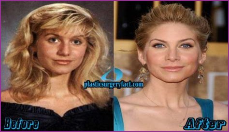 Elizabeth Mitchell Plastic Surgery Before and After