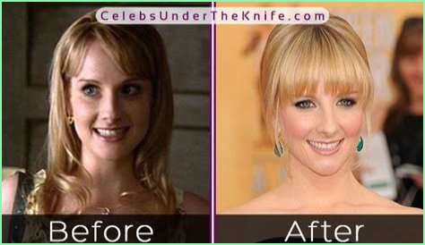 Melissa Rauch Plastic Surgery Before and After